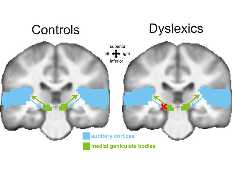 Brain images: Controls vs. Dyslexics