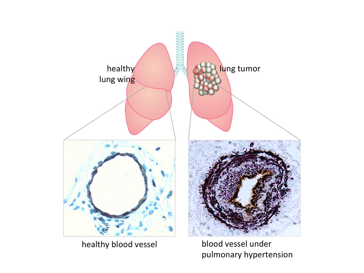 lung cancer cells diagram