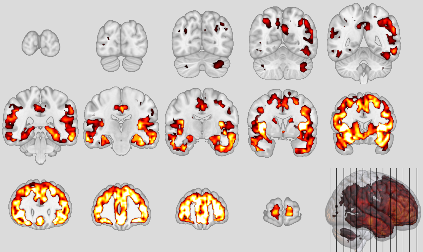 Patrones neuroanatómicos de la variante conductual de la demencia frontotemporal (arriba) y la esquizofrenia