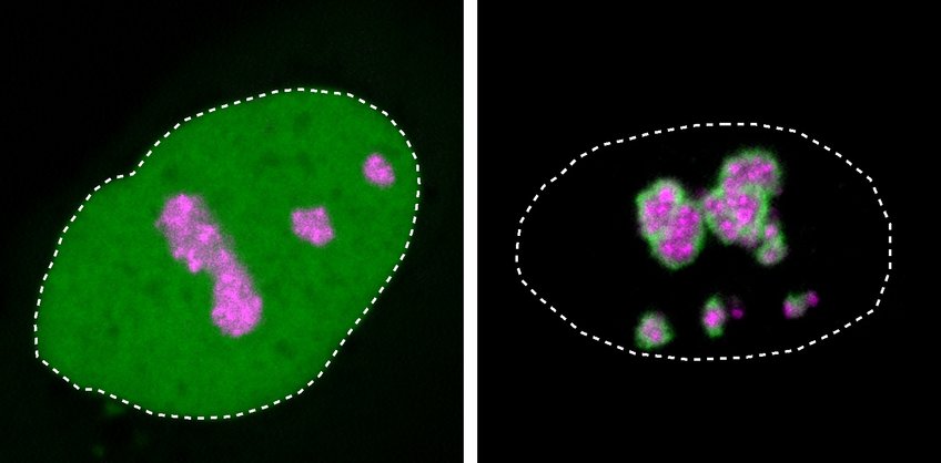 Close-ups of cell nuclei in a human cell culture: HMGB1 protein (green) is usually found throughout the nucleus (dotted line). Mutant HMGB1, shown on the right, preferentially localizes at the nucleolus (marked in magenta) and forms a solidified layer over it, which causes disease. 