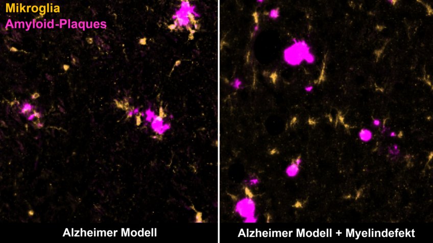 Specific immune cells, microglia (yellow), clear amyloid plaques (purple) in the brain of a mouse with Alzheimer's disease (left).  Demyelination distracts them from it (right).