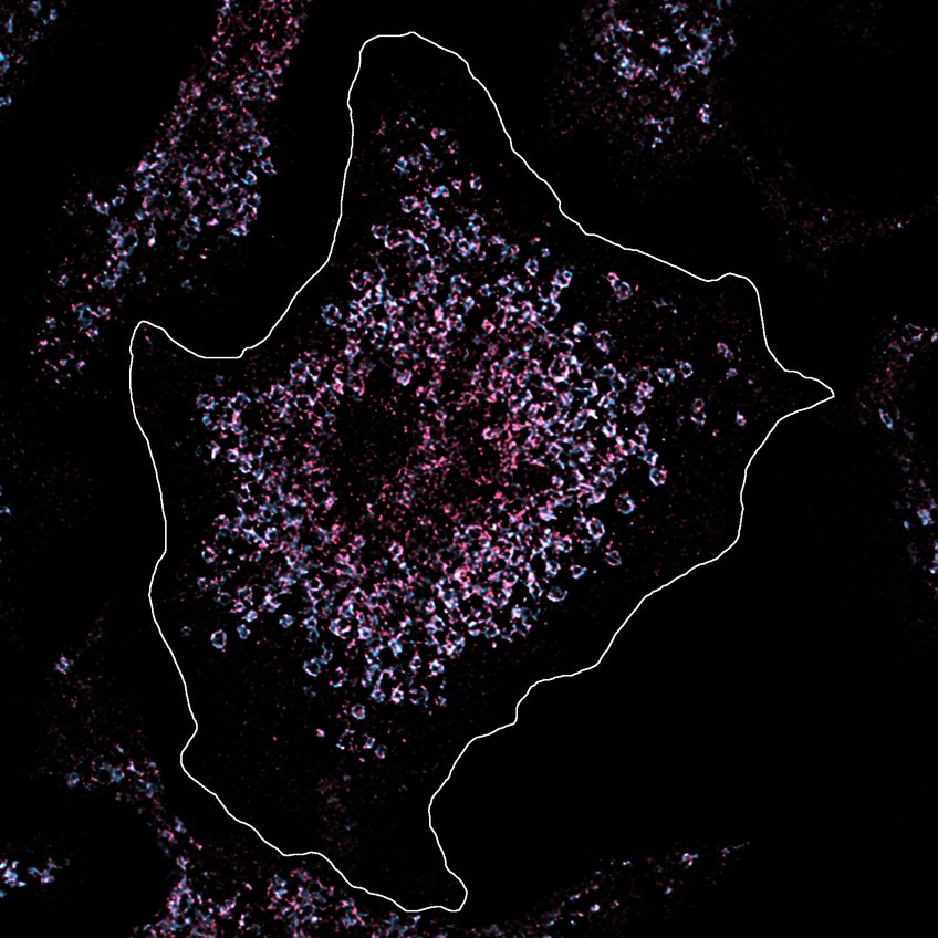 In this cell, Toll-like receptor 7 was stained pink in order to analyse its amount and position under the microscope. The cell is healthy and the amount of Toll-like receptor is normal. The situation is different in the immune cells of lupus patients, which have a significantly increased number of receptors, whereby the body's own genetic material is recognised and the chronic inflammation of lupus is triggered.