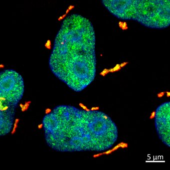 After UV-induced RNA damage, the proteins DHX9 (green) and G3BP1 (red) form stress granules in the cytoplasm. 