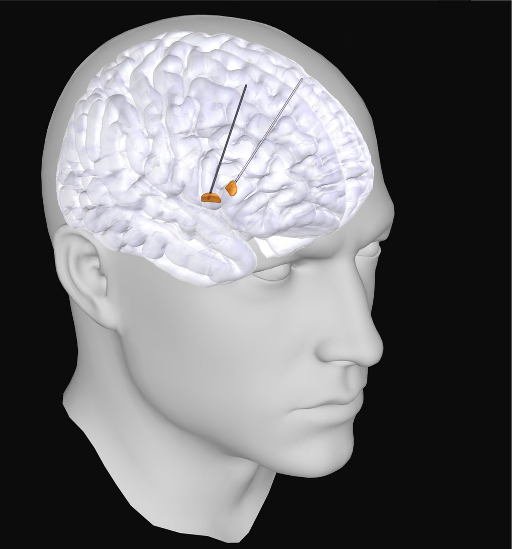Anatomical depiction of a human brain model, featuring multiple electrodes strategically positioned on the brain surface, highlighting the intricate brain structure and its connection points.